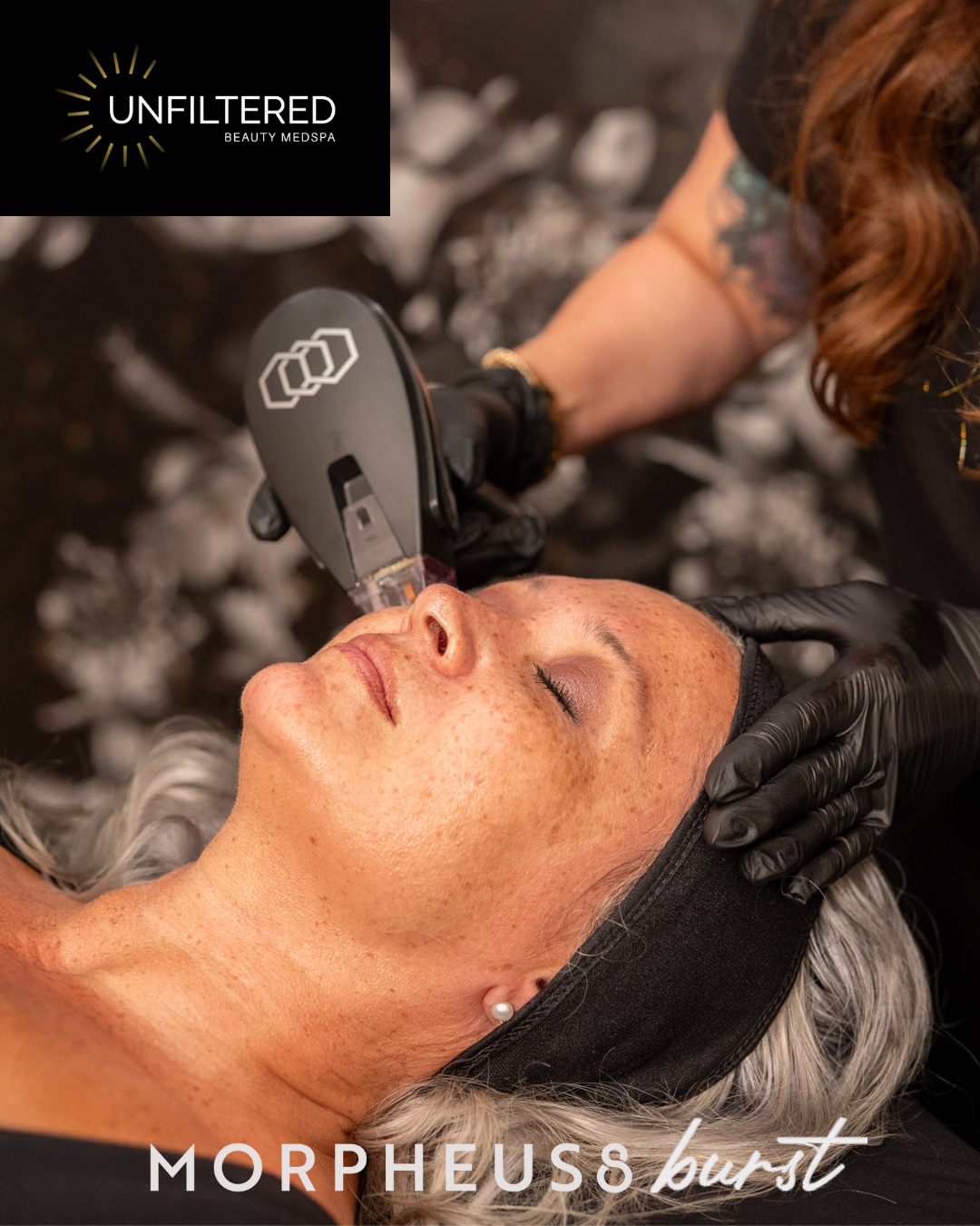 Morpheus8 RF Microneedling Services