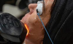 IPL for Face, Neck, & Chest